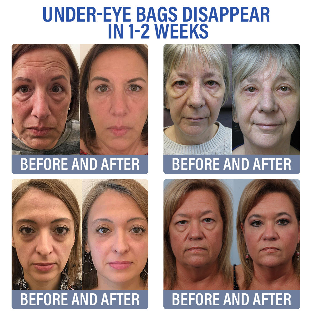 ✅Official Store | flysmus® Botox Retinol Eye Cream 🧑🏼⚕️Dermatologist Recommended (Eye Cream for Fine Lines, Wrinkles, Dark Circles, Dark Spots, and Daily Anti-Aging)