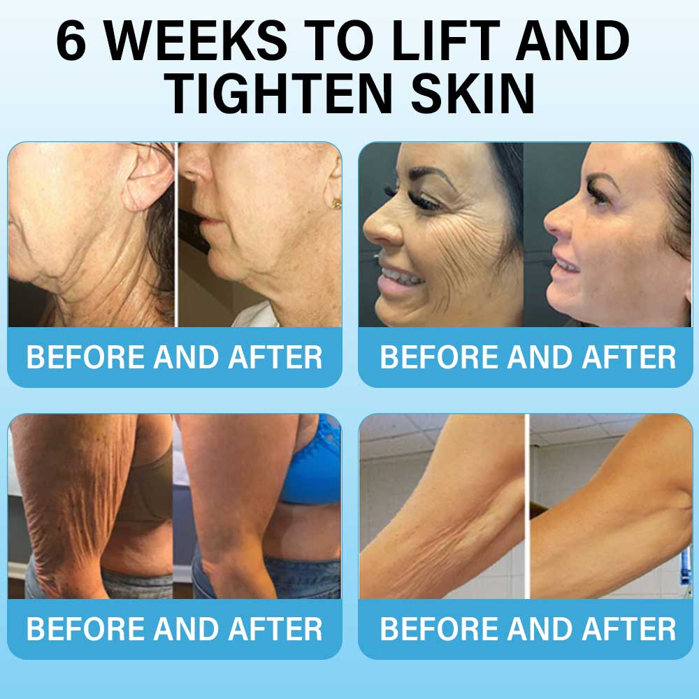 Last Day Discount:75%OFF: Furzero™ Skin Lifting Wrinkle Removal Cream:Restore Skin Elasticity-2024 AU