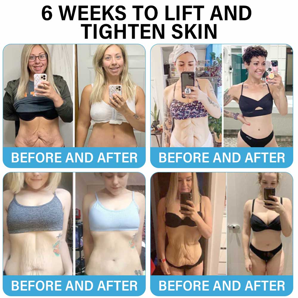 Last Day Discount:75%OFF: Furzero™ Skin Lifting Wrinkle Removal Cream:Restore Skin Elasticity-2024 AU