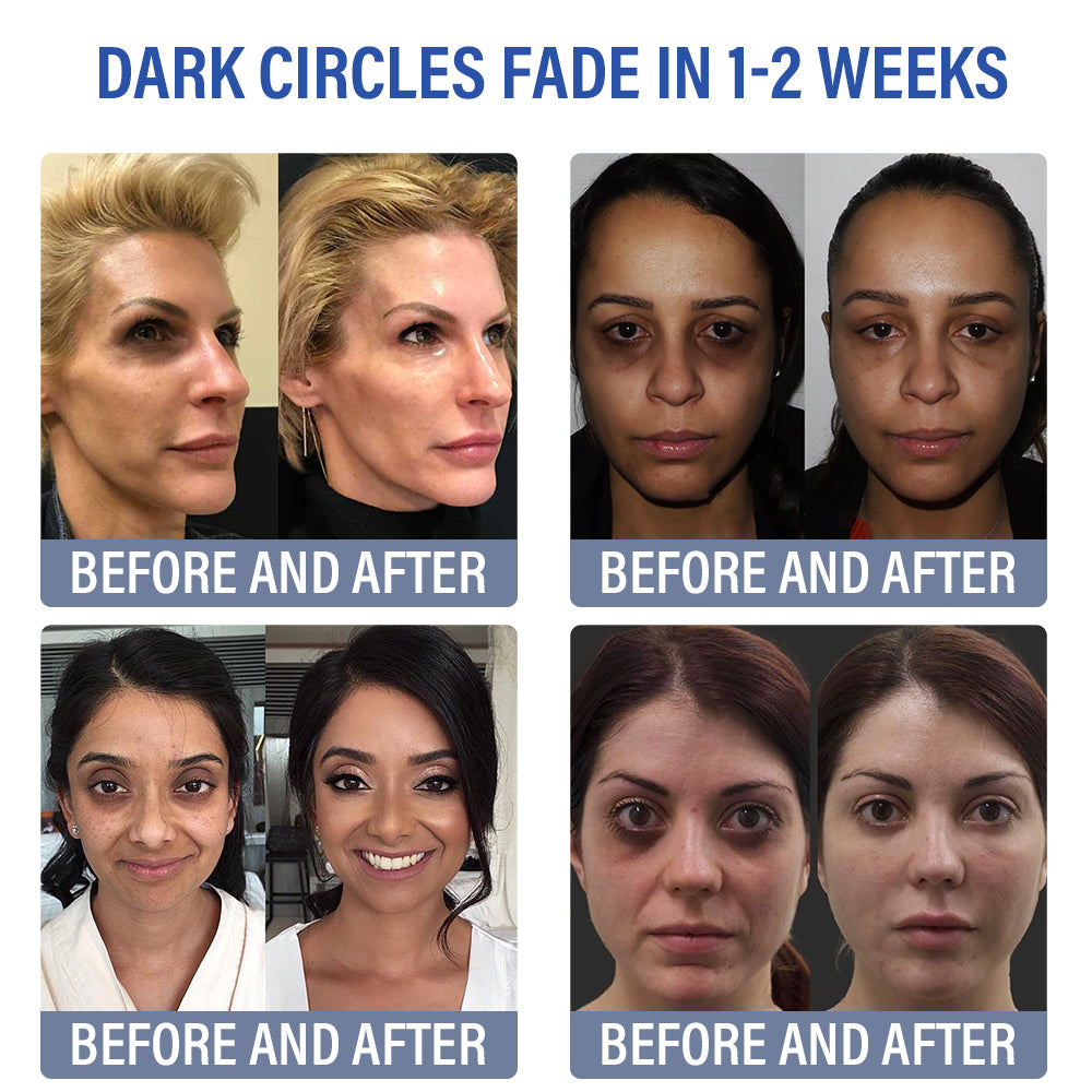 ✅Official Store | flysmus® Botox Retinol Eye Cream 🧑🏼⚕️Dermatologist Recommended (Eye Cream for Fine Lines, Wrinkles, Dark Circles, Dark Spots, and Daily Anti-Aging)