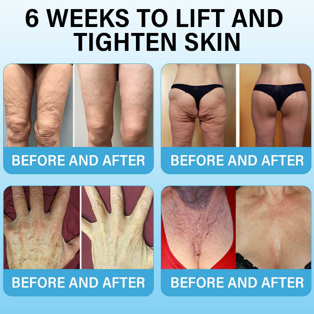Last Day Discount:75%OFF: Furzero™ Skin Lifting Wrinkle Removal Cream:Restore Skin Elasticity-2024 AU