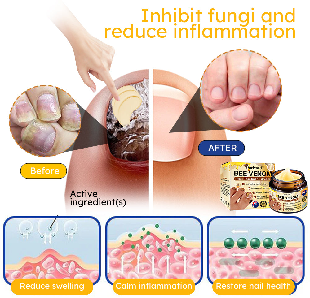 Ourlyard™ Bee Venom Nail Fungus Treatment Solution:Completely solve the nail fungus problem👣